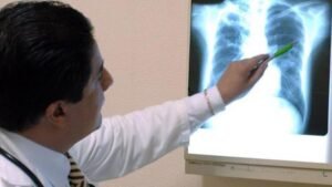 Aumentan los casos de tuberculosis infantil en Jalisco por baja vacunación