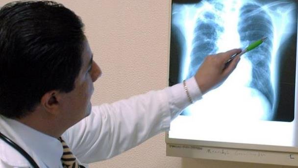Aumentan los casos de tuberculosis infantil en Jalisco por baja vacunación